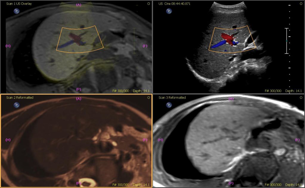 MR and Ultrasound fusion