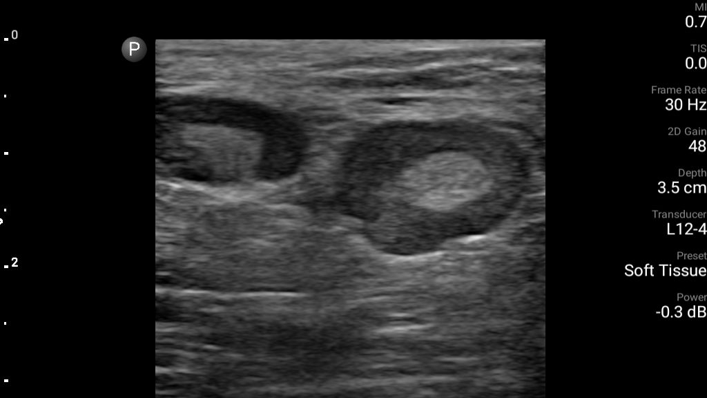 Enlarged lymph nodes shown using L12-4 transducer on Lumify.