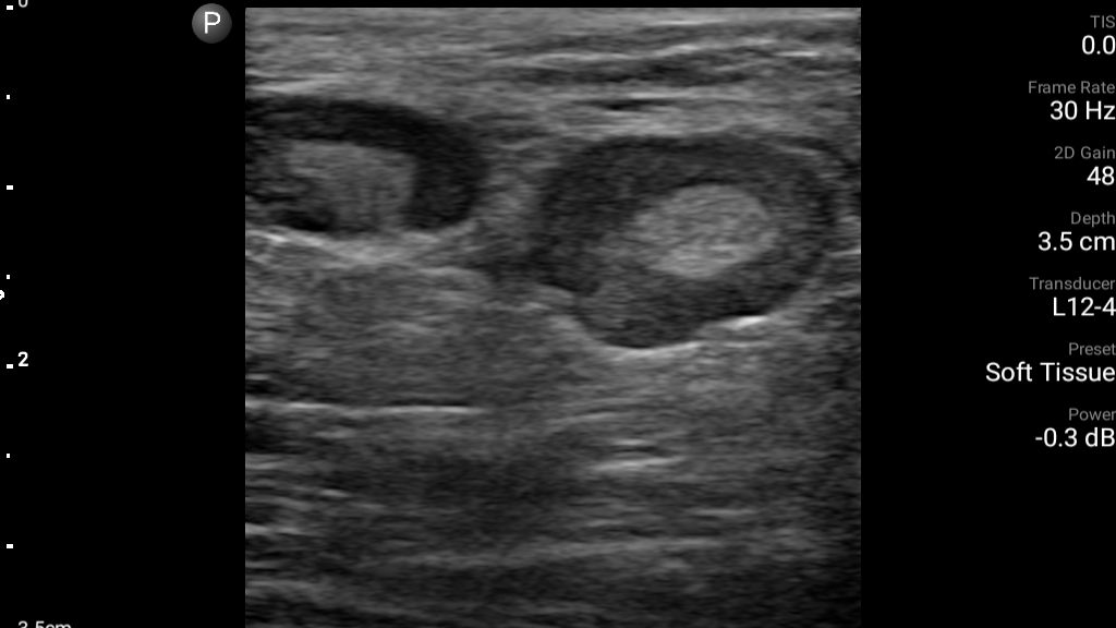 Enlarged lymph nodes shown using L12-4 transducer.