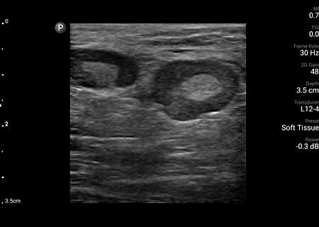 Enlarged lymph nodes shown using L12-4 transducer.