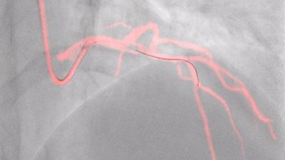 Philips Dynamic Coronary Roadmap showing real-time coronary vessel visualization during PCI
