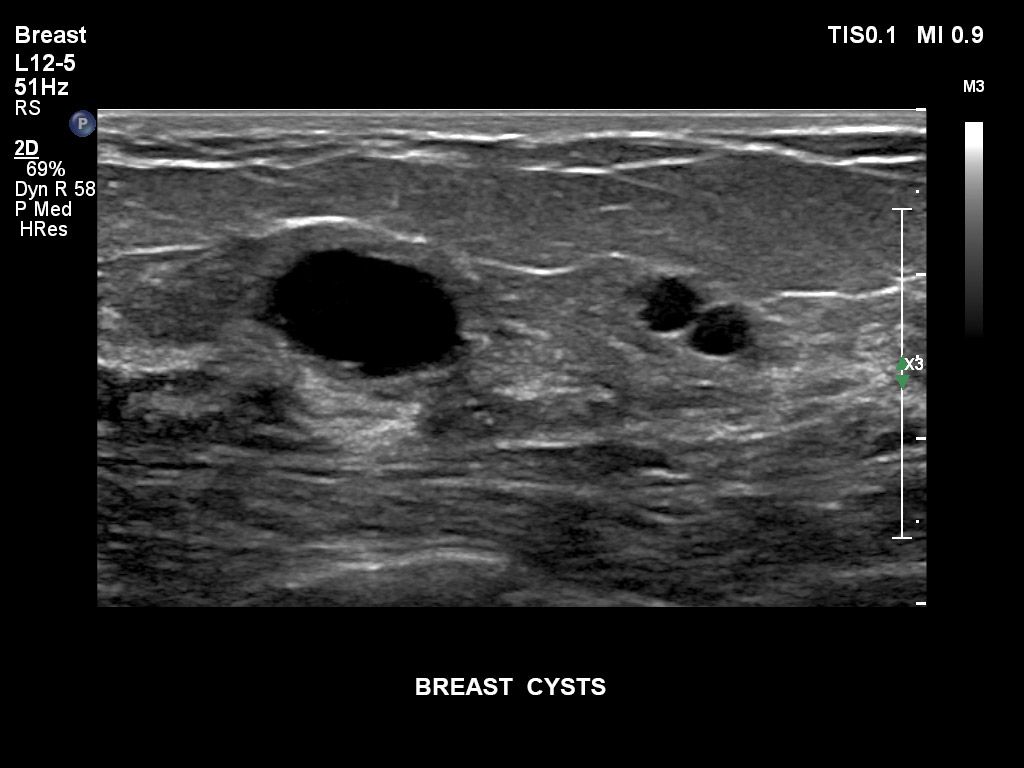 Breast cysts