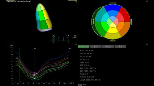 Ultrasound Workspace 4D LV-ANALYSIS 1
