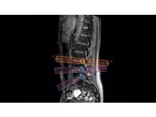 SmartExam Wirbelsäule Klinische MR-Anwendung