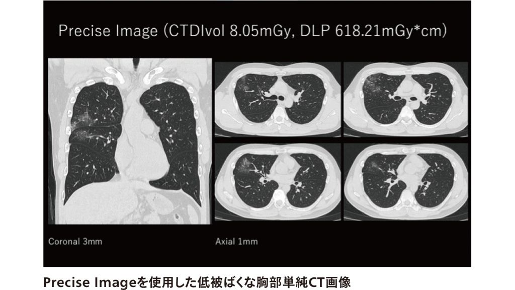 Precise Imageを使用した低被ばくな胸部単純CT画像