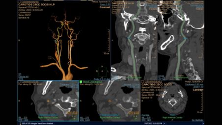 Advanced vessel analysis with spectral results