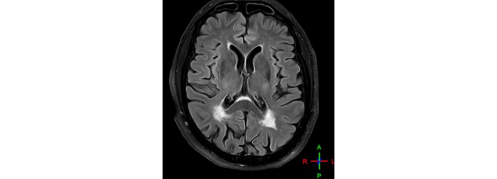 Axial 3D BrainView FLAIR