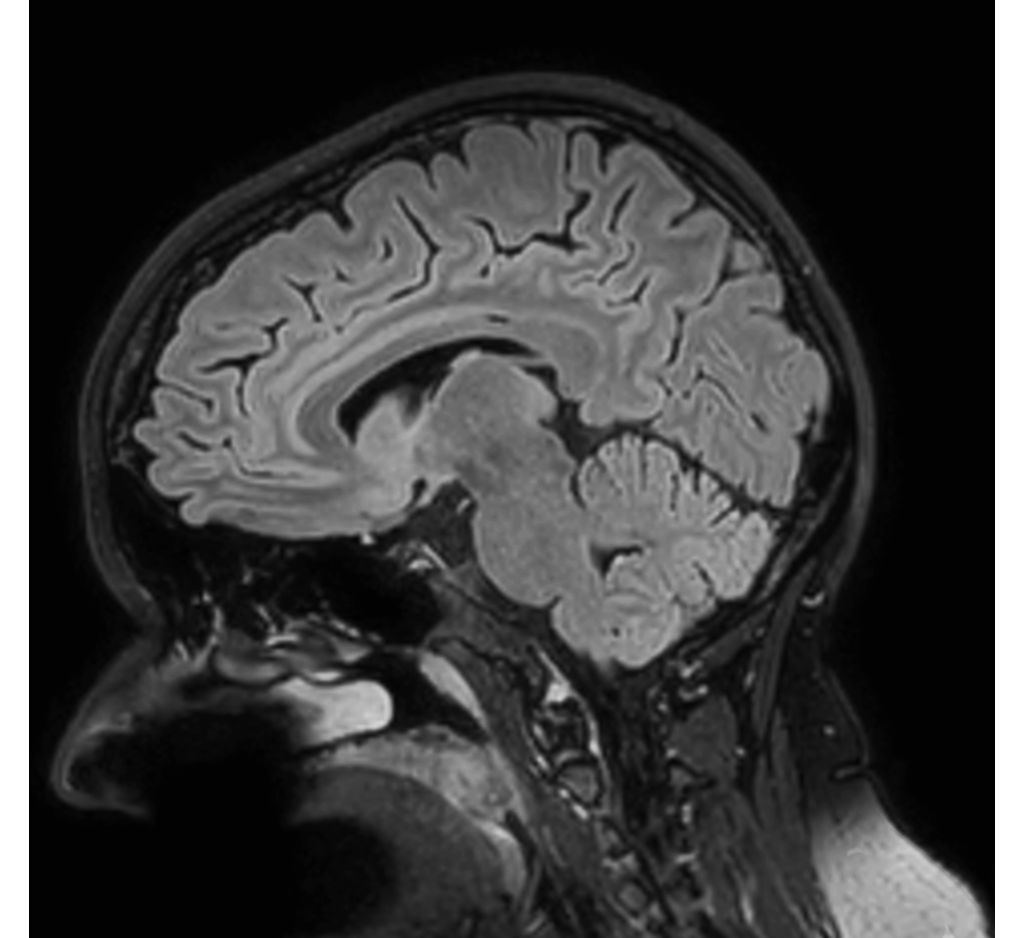 Sagittal 3D BrainView FLAIR