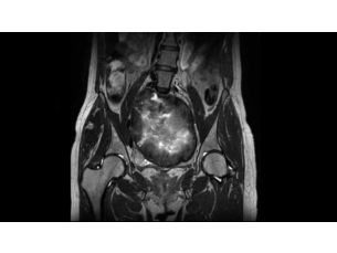 Compressed SENSE - Pelvis MR Clinical Applications