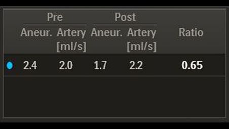 Nueva información con relación de amplitud media del flujo del aneurisma (Mean Aneurysm Flow Amplitude)