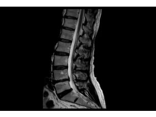 SmartSpeed Precise - Spine MR Clinical Applications