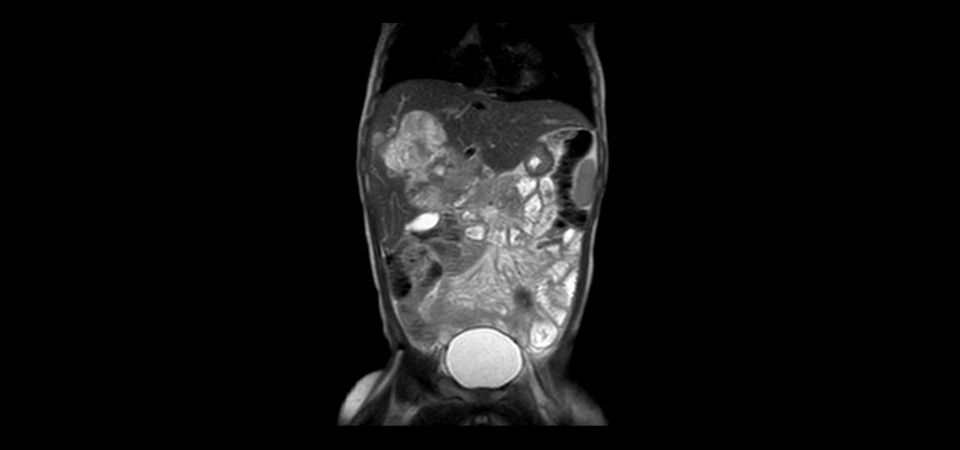 Coronal T2w TSE (2 year old)