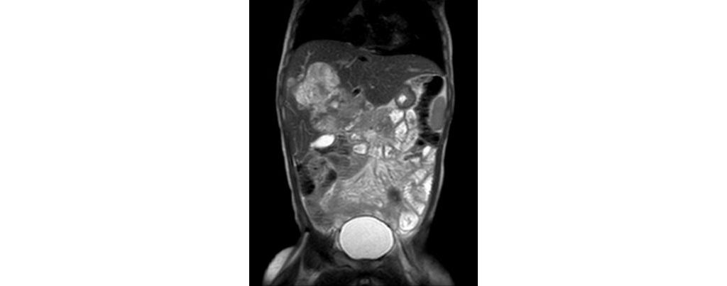 Coronal T2w TSE (2 year old)