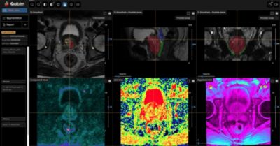 Pelvic MRI images on Philips imaging software showing multiparametric views with color-coded prostate tumor segmentation