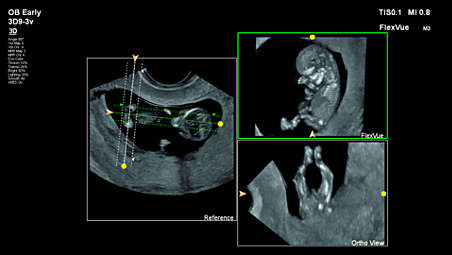 FlexVue with Orthogonal View