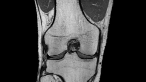 3D MSK VIEW - PDw TSE (coronal reformat)