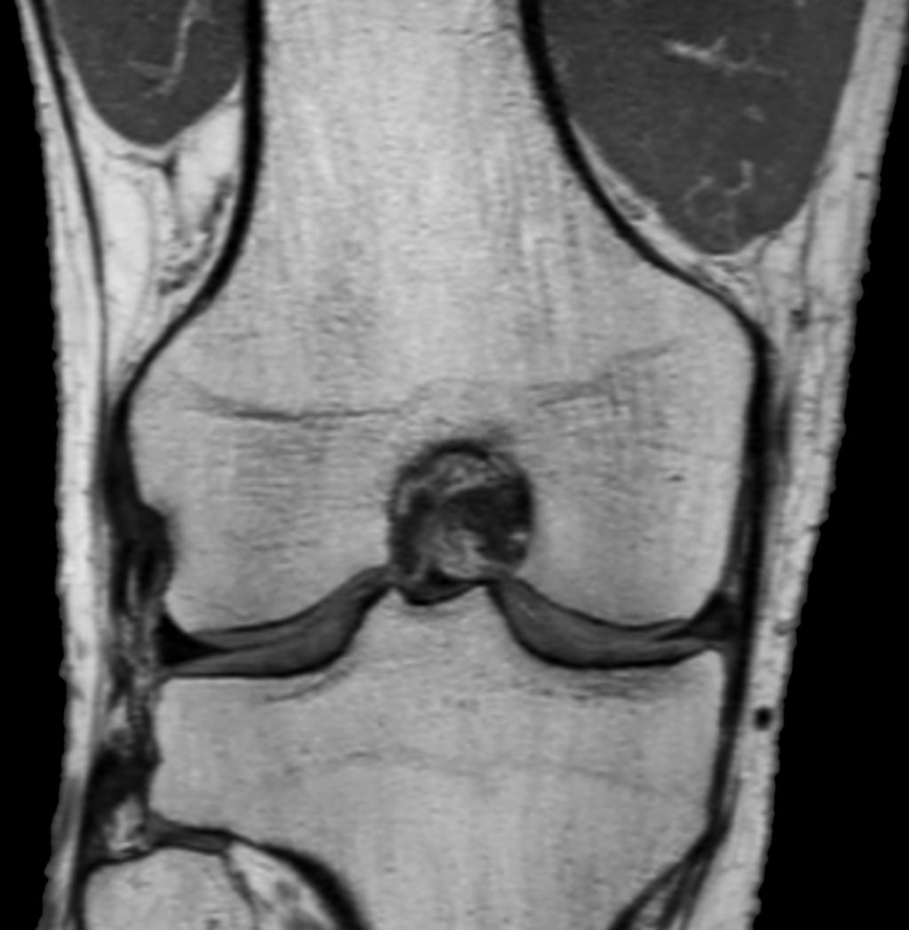 3D MSK VIEW - PDw TSE (coronal reformat)