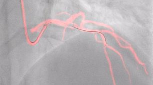 Dynamic Coronary Roadmap 