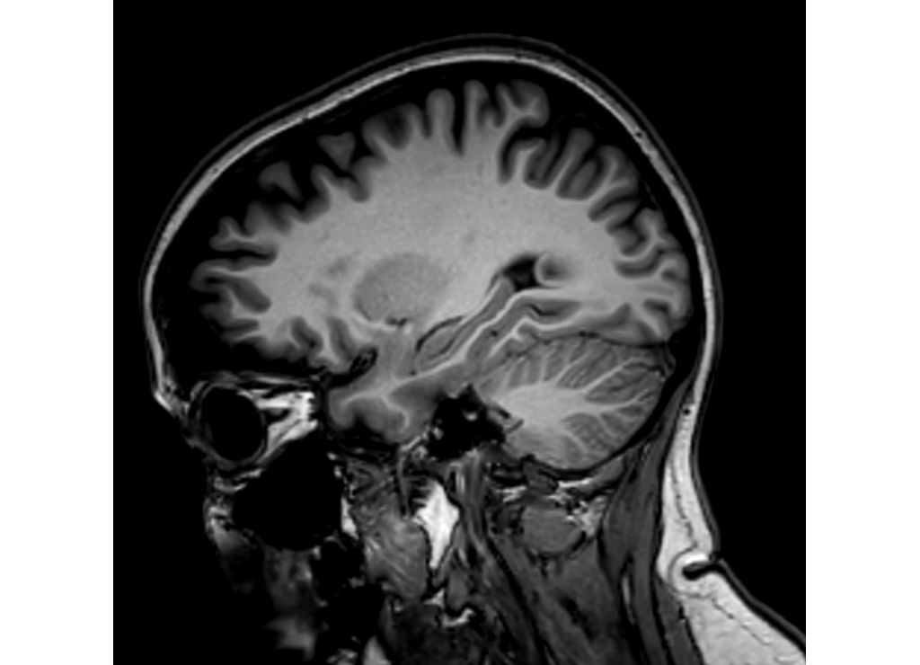 Sagittal 3D BrainVIEW T1w FFE