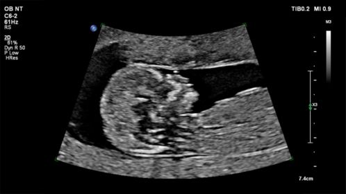 Fetal ultrasound profile image shown using C6-2 transducer