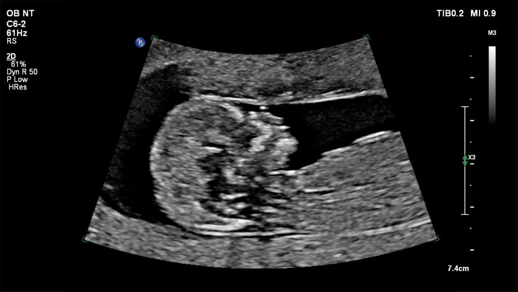 Fetal ultrasound profile image shown using C6-2 transducer