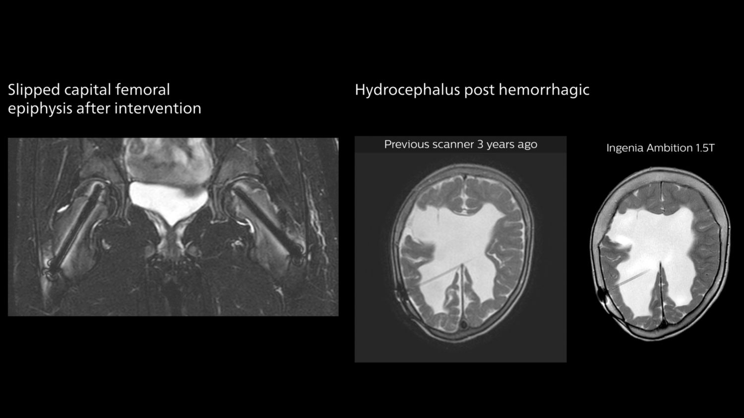 Slipped capital femoral epiphysis after intervention and hydrocephalus post hemorrhagic