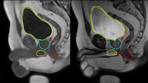 MRCAT prostate + Auto-Contouring