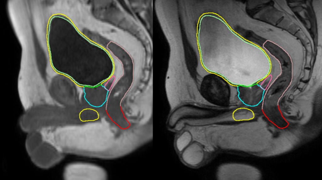 MRCAT prostate + Auto-Contouring