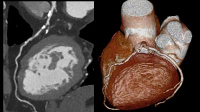 Imagerie cardiaque Incisive montrant les détails du cœur