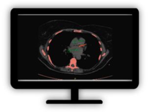 CT Calcium Scoring​ One-click 3D calcium segmentation