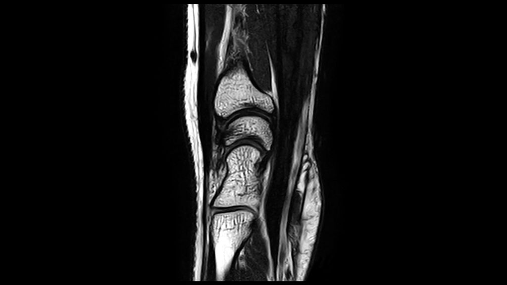 T2W TSE Sag