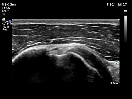 L12-5 MSK Biceps Tendon