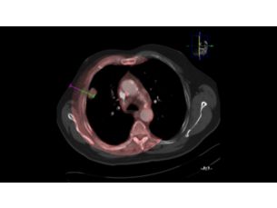 XperGuide Live 3D needle guidance