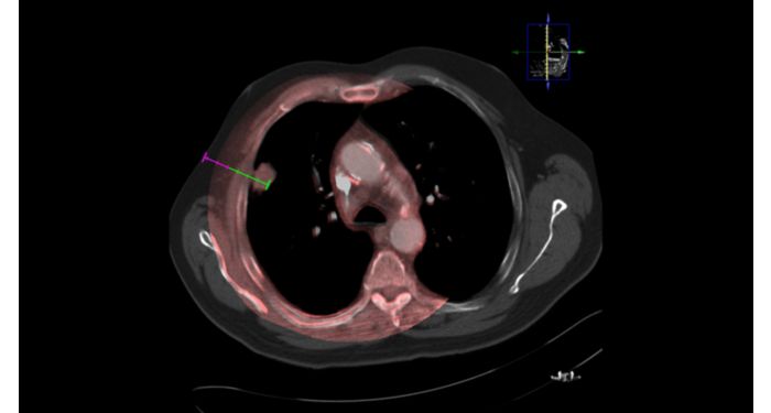 XperGuide  Live 3D needle guidance