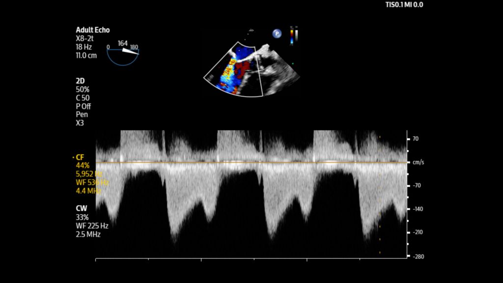 Adult echo with mitral valve regurgitation shown with color using X8-2t transducer.