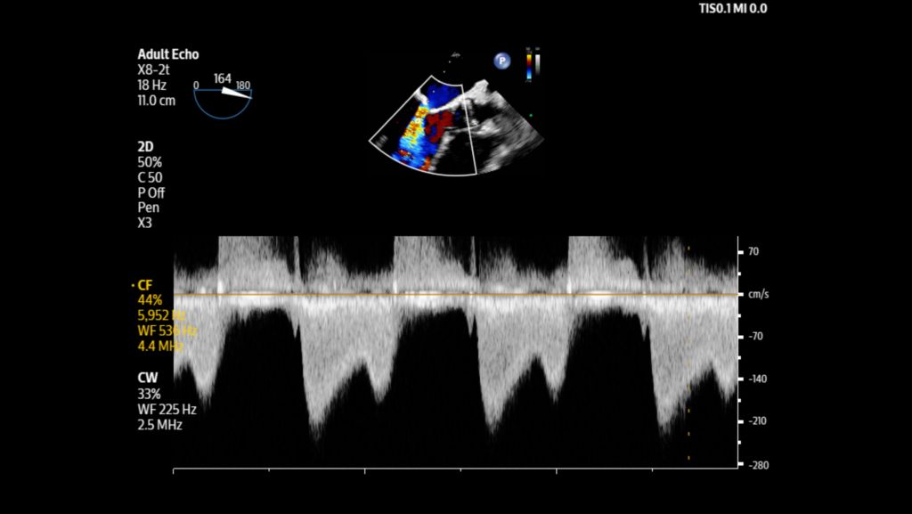 Adult echo with mitral valve regurgitation shown with color using X8-2t