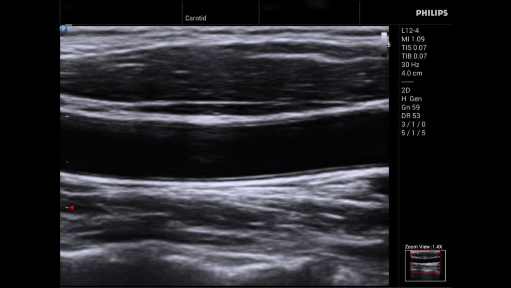 L12-4 Common Carotid Artery