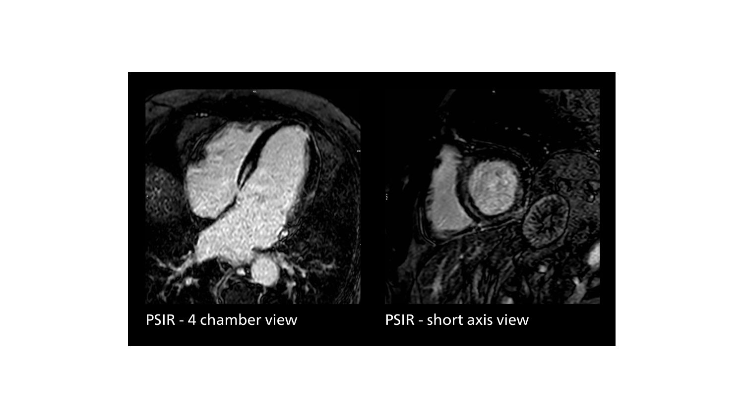 Cardiac MR of non-ischemic cardiomyopathy showing delayed enhancement and severe mitral regurgitation.