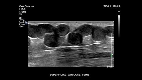 Superficial varicose veins