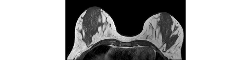 T1w TSE - Breast