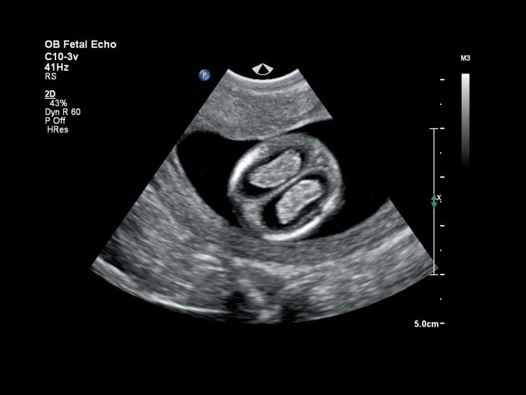Fetal head image at 12 weeks gestation from the Affiniti 70