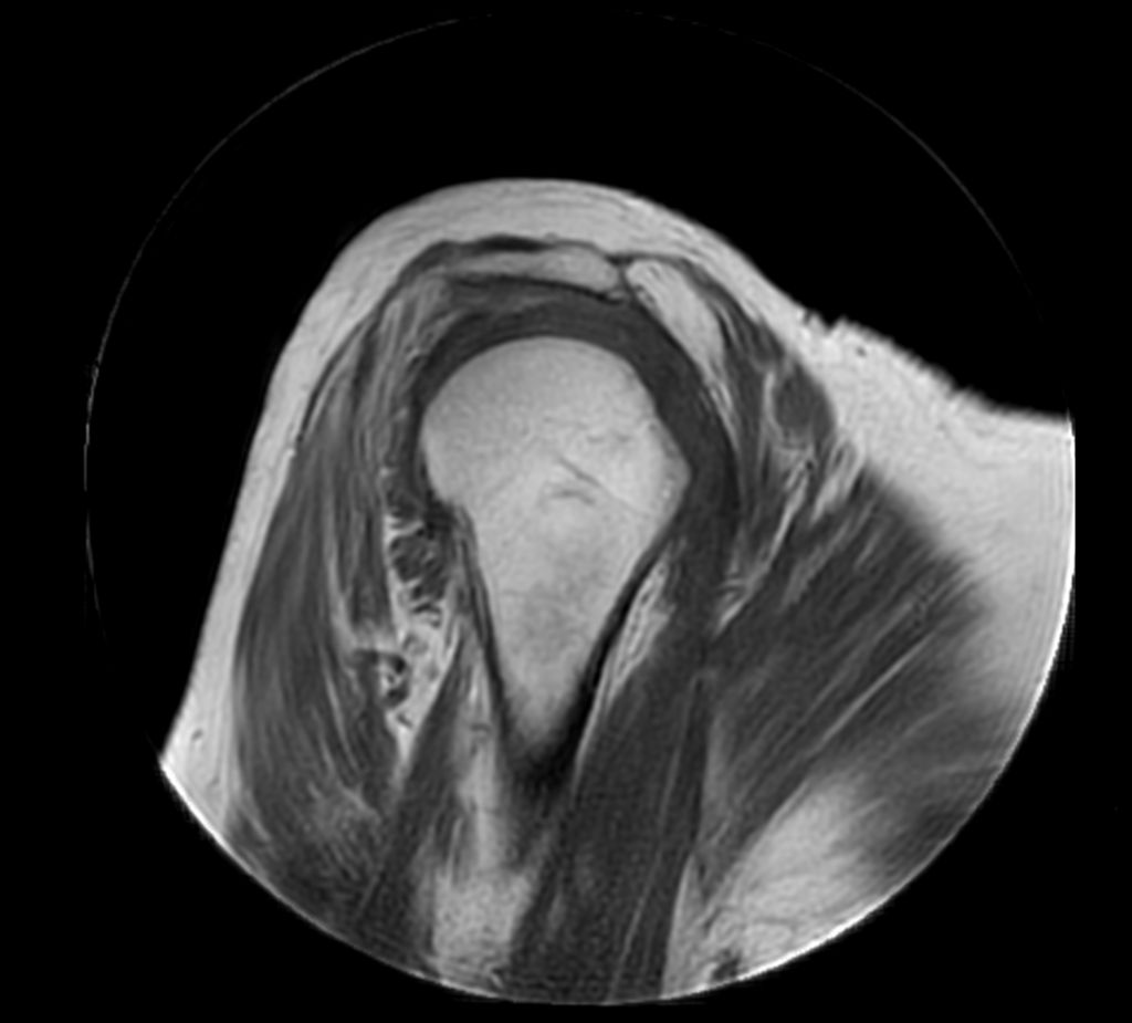 MultiVane XD - Sagittal T1w TSE