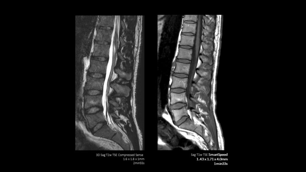 SmartSpeed -Spine