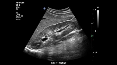 glomerulonephritis ultrasound