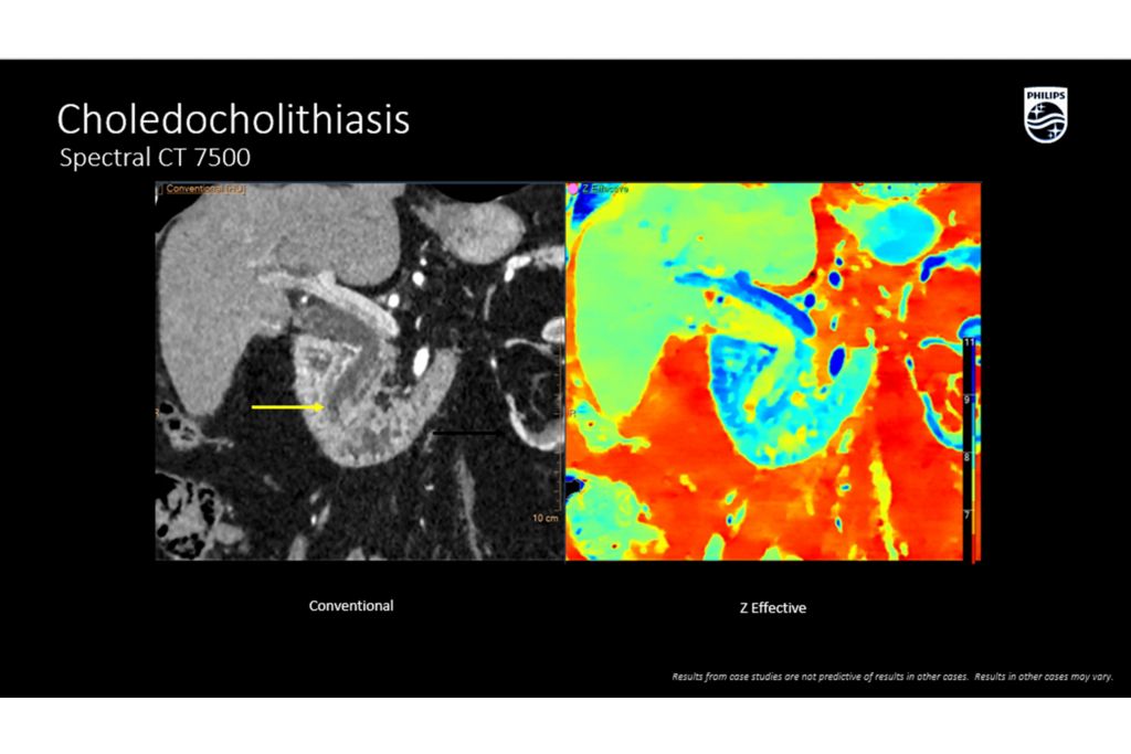 CT Spectral 7500 Choledocholithiasis