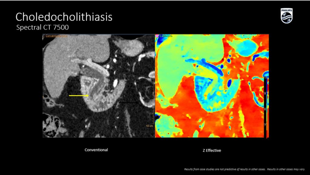 CT Spectral 7500 Choledocholithiasis