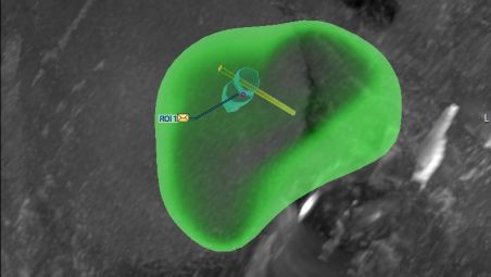 Wertvolles Feedback durch Überblendung gespeicherter Biopsieziele