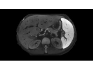 SmartSpeed Diffusion - Abdomen Aplicaciones clínicas para RM