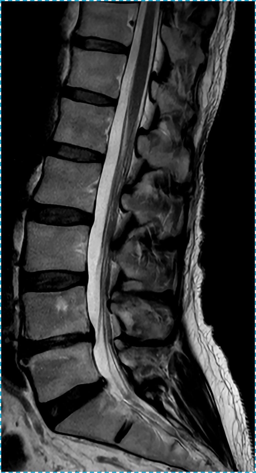 L Spine T2 TSE