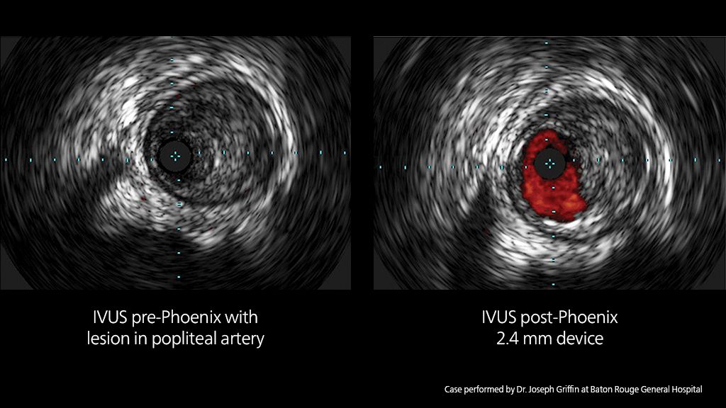 Phoenix created 67% luminal gain without vessel injury [11,12]*​